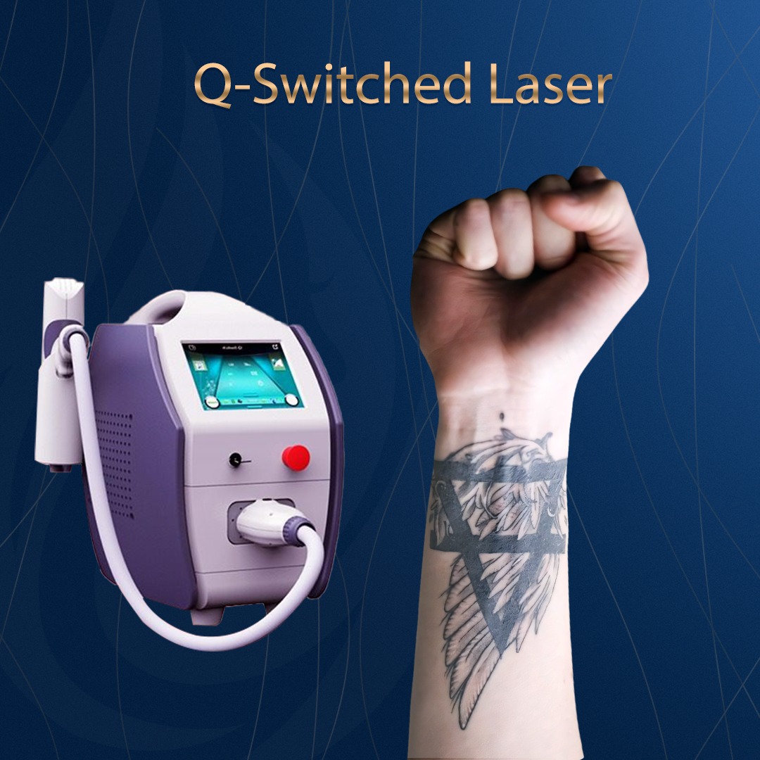 إزالة التاتو بجهاز Q-Switched